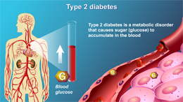 Understanding Type 2 Diabetes - Animation