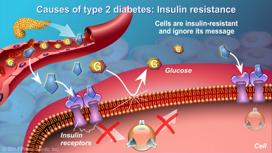 causes of type 2 diabetes